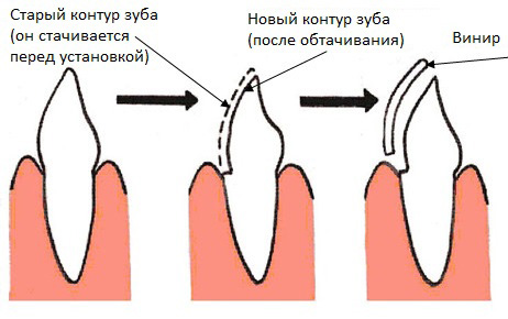 Этапы установки винира