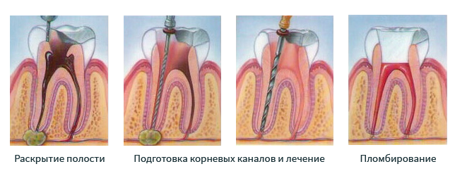 Пломбирование каналов