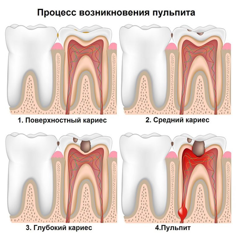 Процесс возникновения заболеваний зубов