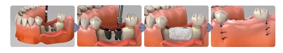 атрофия кости челючти