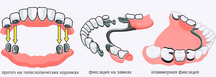 разновидности бюгельных протезов