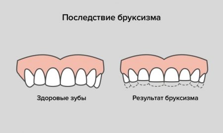 Последствие бруксизма