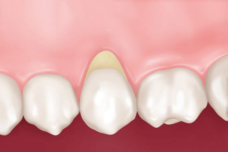 Что такое и как лечить клиновидный дефект зубов – Стоматология ...