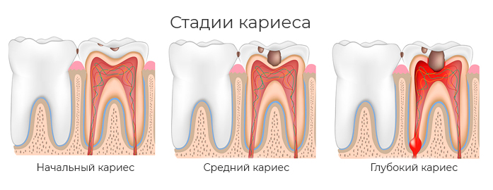 Лечение кариеса молочных зубов
