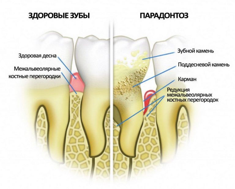 Пародонтоз схематически
