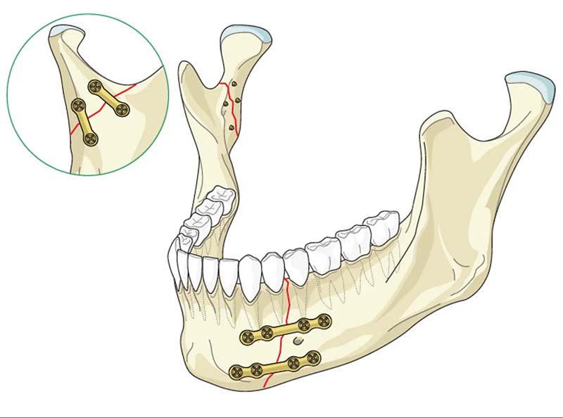 План лечения при переломе нижней челюсти