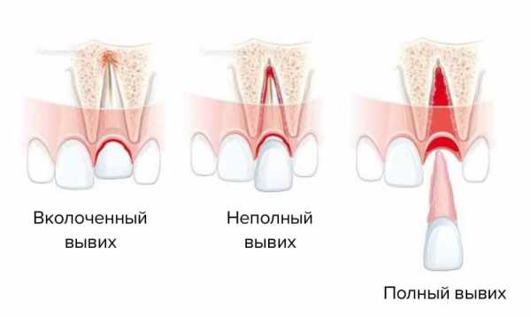 Виды вывиха зубов