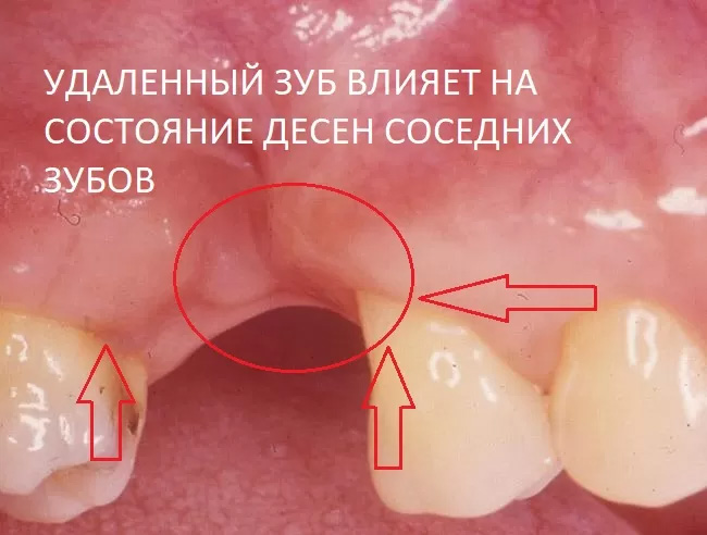 причины опущения десен