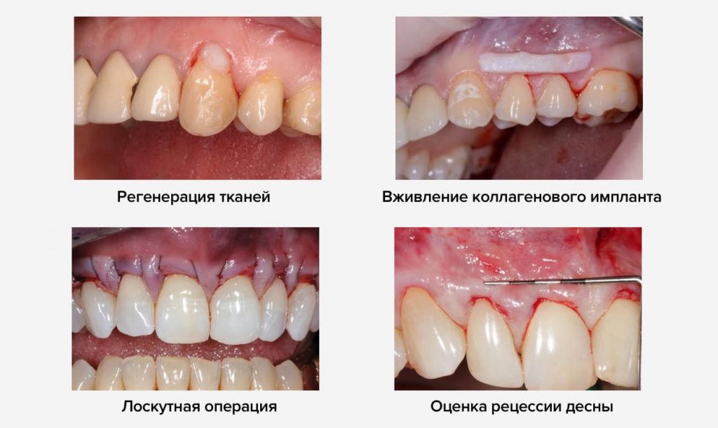 методы устранения рецессии десны