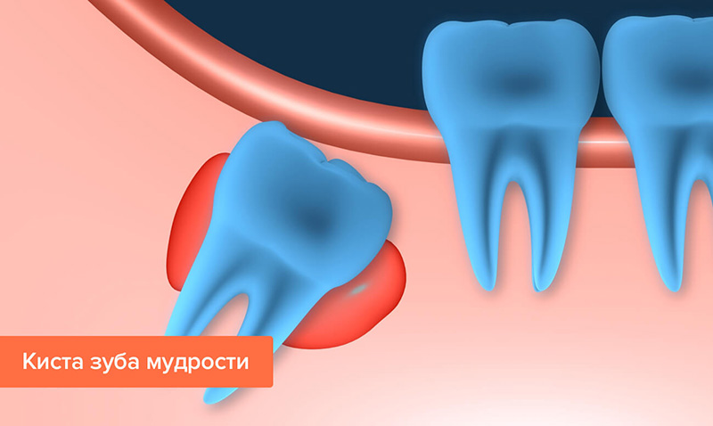 осложнения кист челюстей