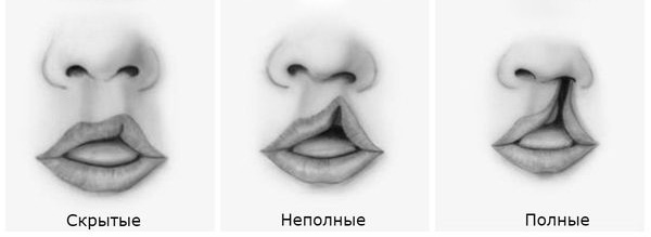 Что такое заячья губа