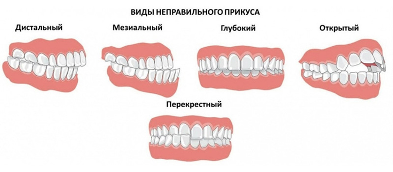виды неправильного прикуса