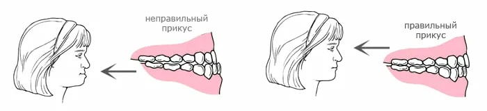 правильный и неправильный прикус