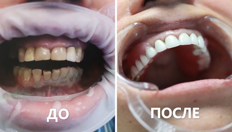 металлокерамика зубы фото до и после