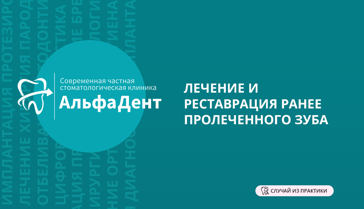 Случай из практики: Лечение и реставрация ранее пролеченного зуба –  Стоматология «АльфаДент» в Оренбурге