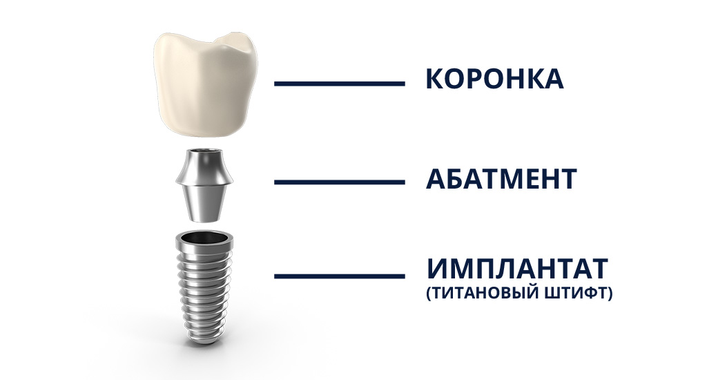 Схема типичного устройства имплантационной конструкции