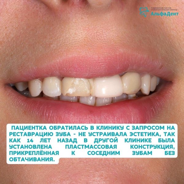 Мостовидная конструкция из диоксида циркони