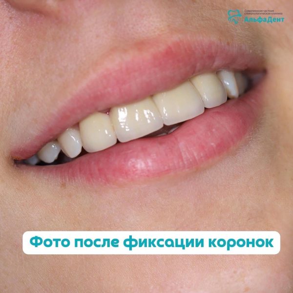 Мостовидная конструкция из диоксида циркони